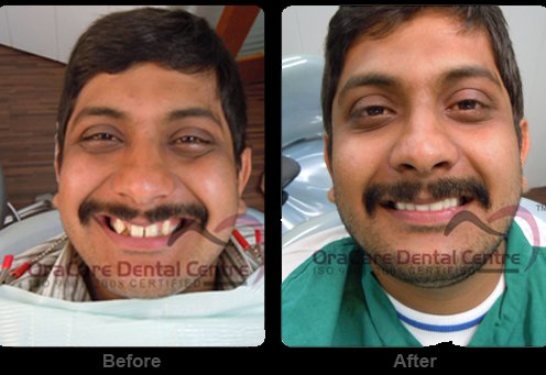 Smile Makeover Treatment