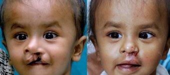 Cleft palate Surgeries