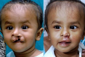 Cleft palate Surgeries